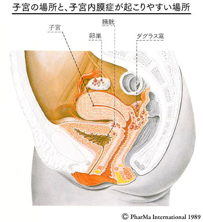 子宮内膜症の図